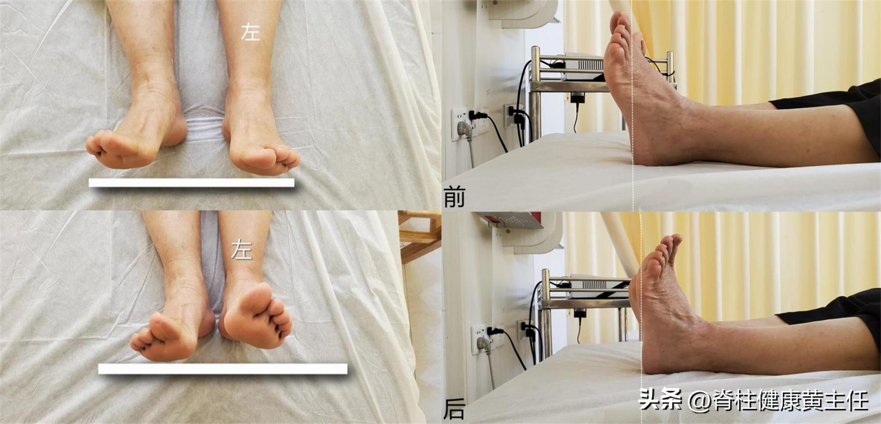 足底疼痛走路时反而症状减轻,足底筋膜炎疼的无法走路怎么缓解