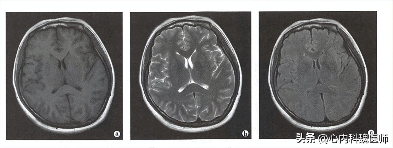 做磁共振检查胸椎要注意哪些事项,磁共振是检查什么病
