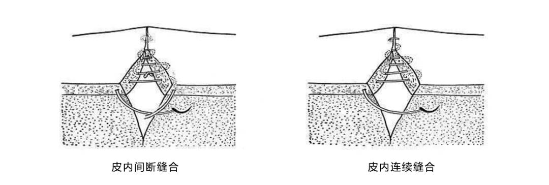 外科各种缝合方法的适用情况,外科操作缝合