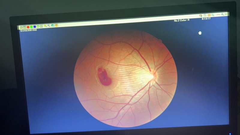 激光视力矫正危害,警惕激光笔对眼睛的损伤