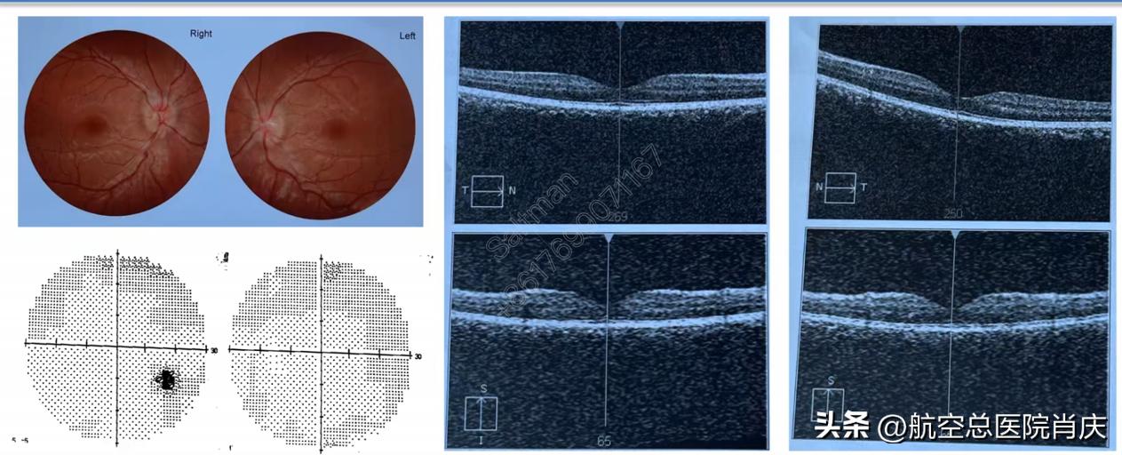 软性神经内镜个性化微创治疗，解除患者多年病痛折磨！