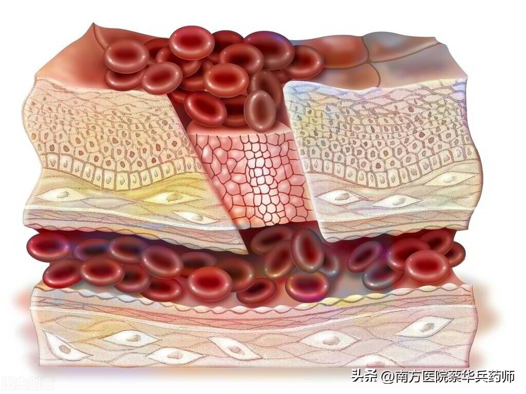 鼻出血中药方剂,中药治鼻出血35例