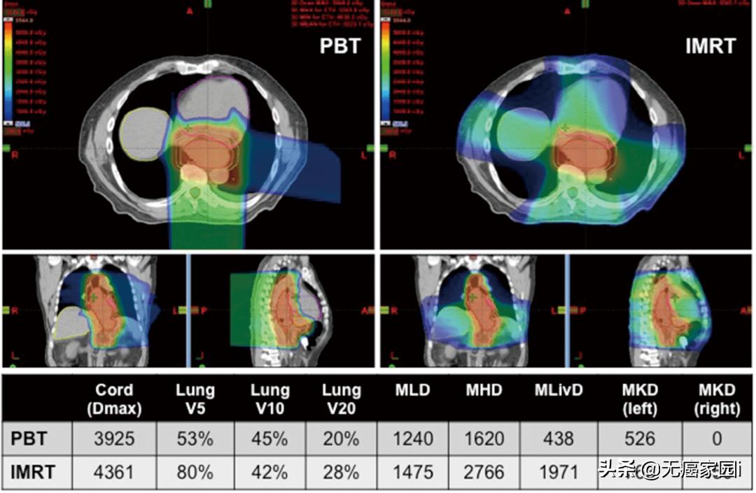 脑瘤、肺癌及儿童肿瘤等不妨考虑质子治疗,疗效和生存质量双保障