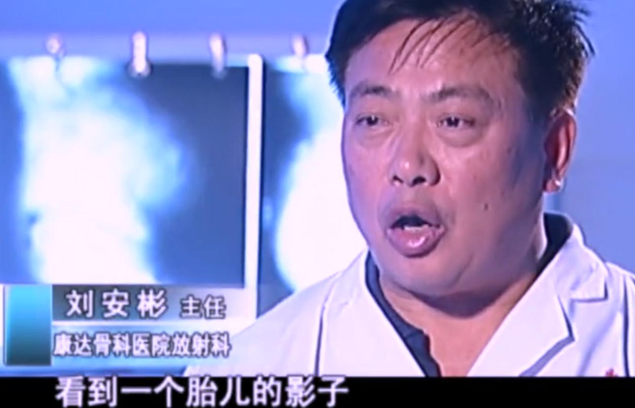 2007年四川90岁老妇，腹中怀子60年未生，后检查发现胎儿没有腐烂