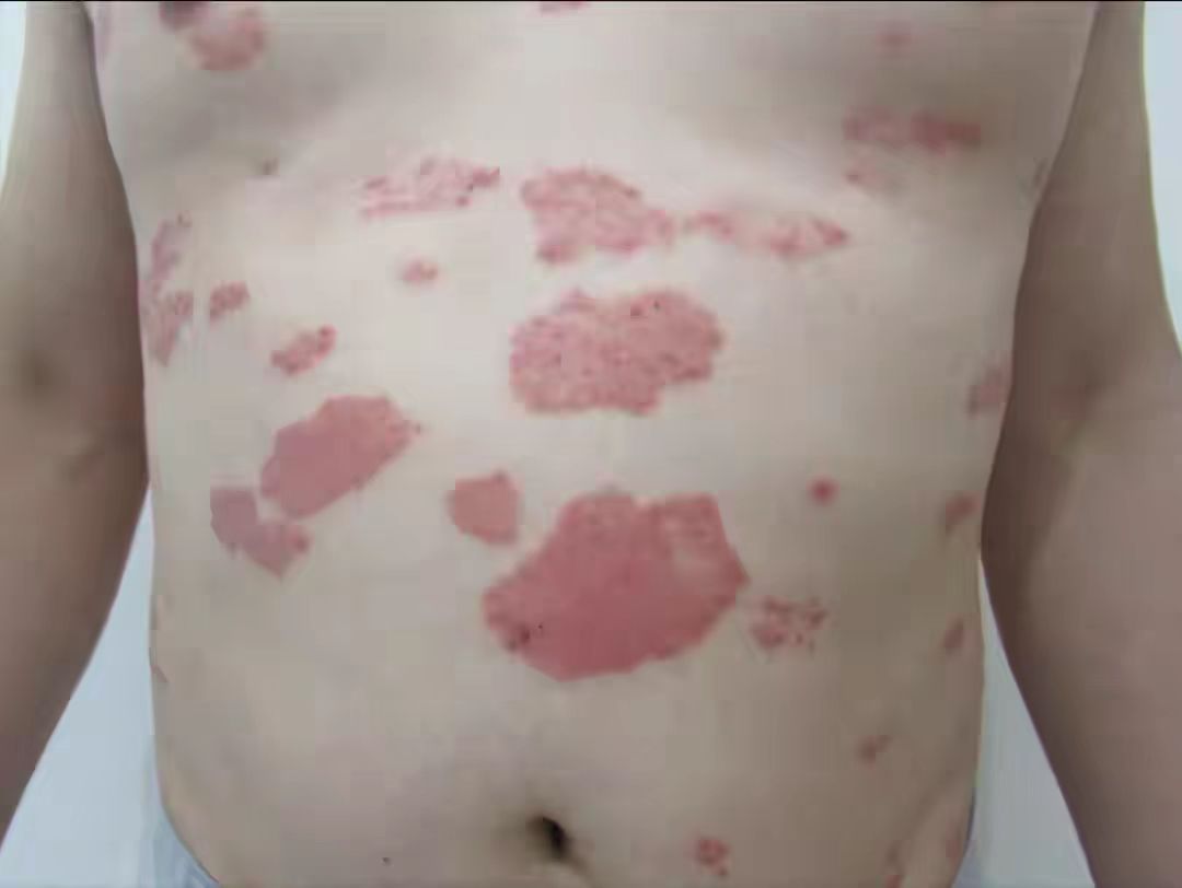 牛皮癣起红斑凸起是不是很严重,身上长牛皮癣的地方发黑发紫