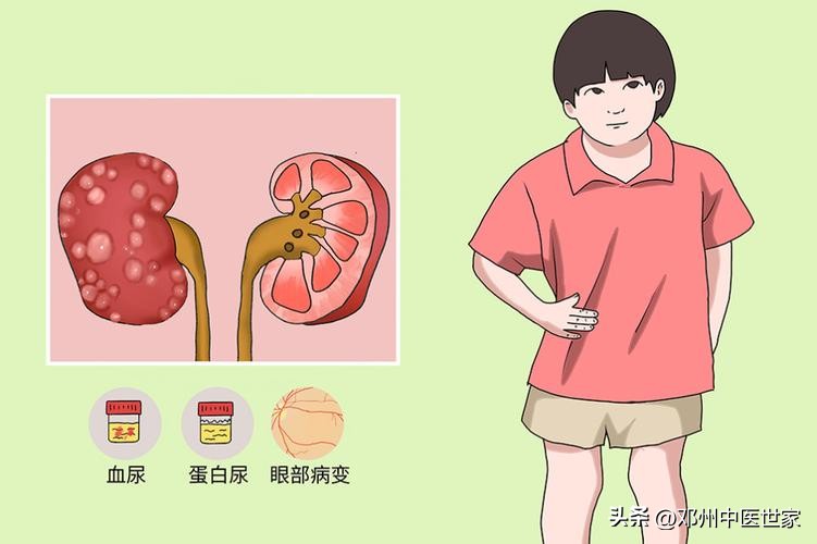 大青龙汤治疗尿毒症水肿,中药汤治尿毒症实例