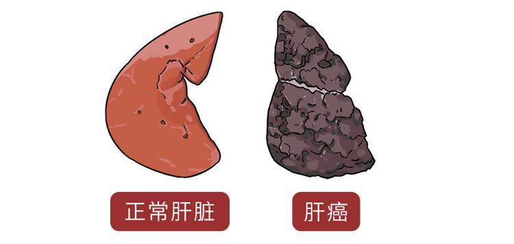 半夜吃烧烤会得癌症吗,经常吃烧烤致什么癌症