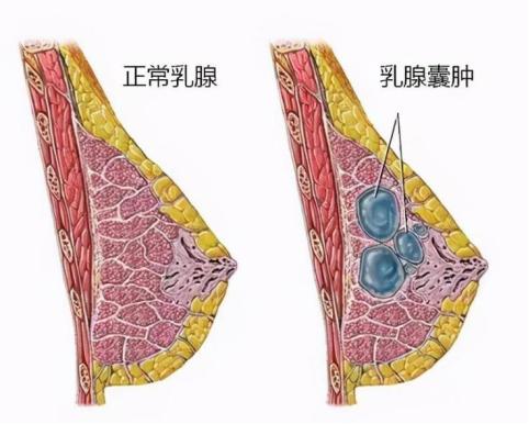 乳腺囊肿一定会癌变吗,乳腺囊肿会引起癌变吗