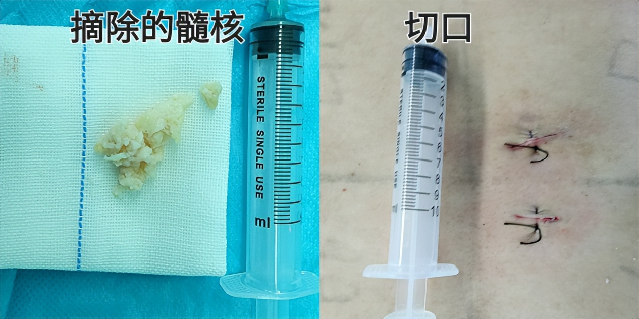 小伙“S”型身材原是腰间盘突出哈医大一院群力骨科团队脊柱上微创摘“核”解除病痛