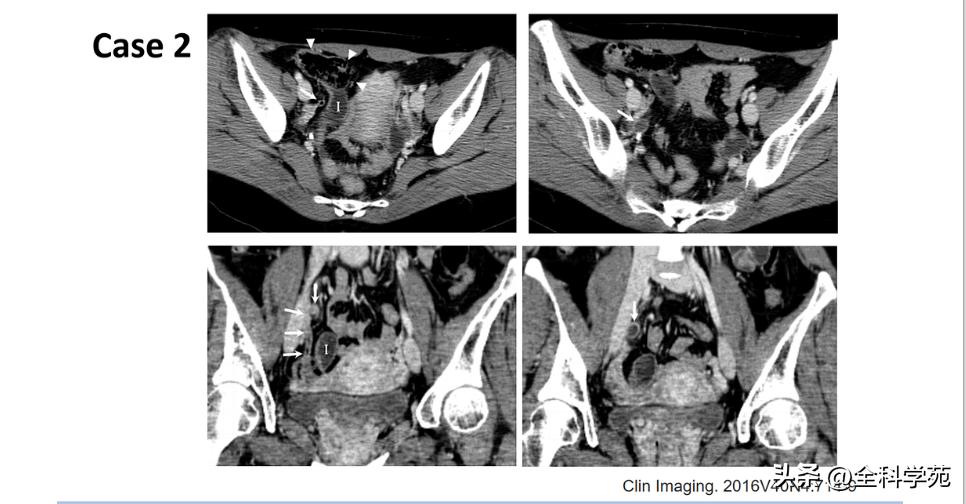 阑尾炎的讲解,关于阑尾炎的讨论总结