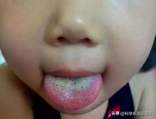 孩子咳嗽发烧反反复复是怎么回事,孩子咳嗽发烧的最佳治疗方法