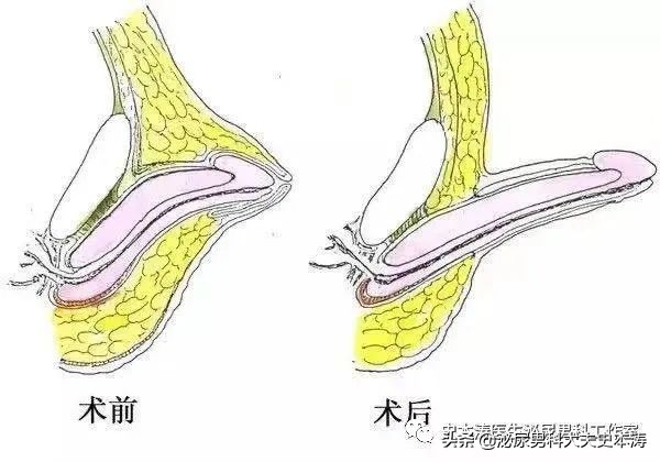 丁丁变形记-“延长/增粗术”