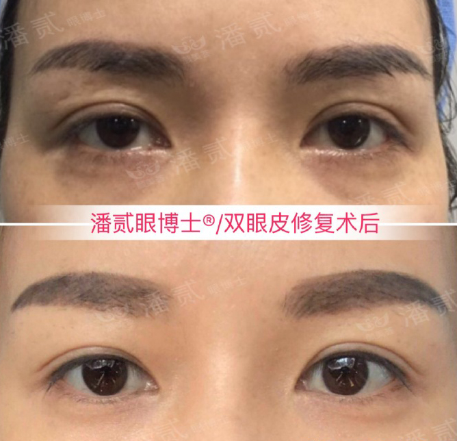 在整形医院割双眼皮多少钱,整形一般做双眼皮多少钱