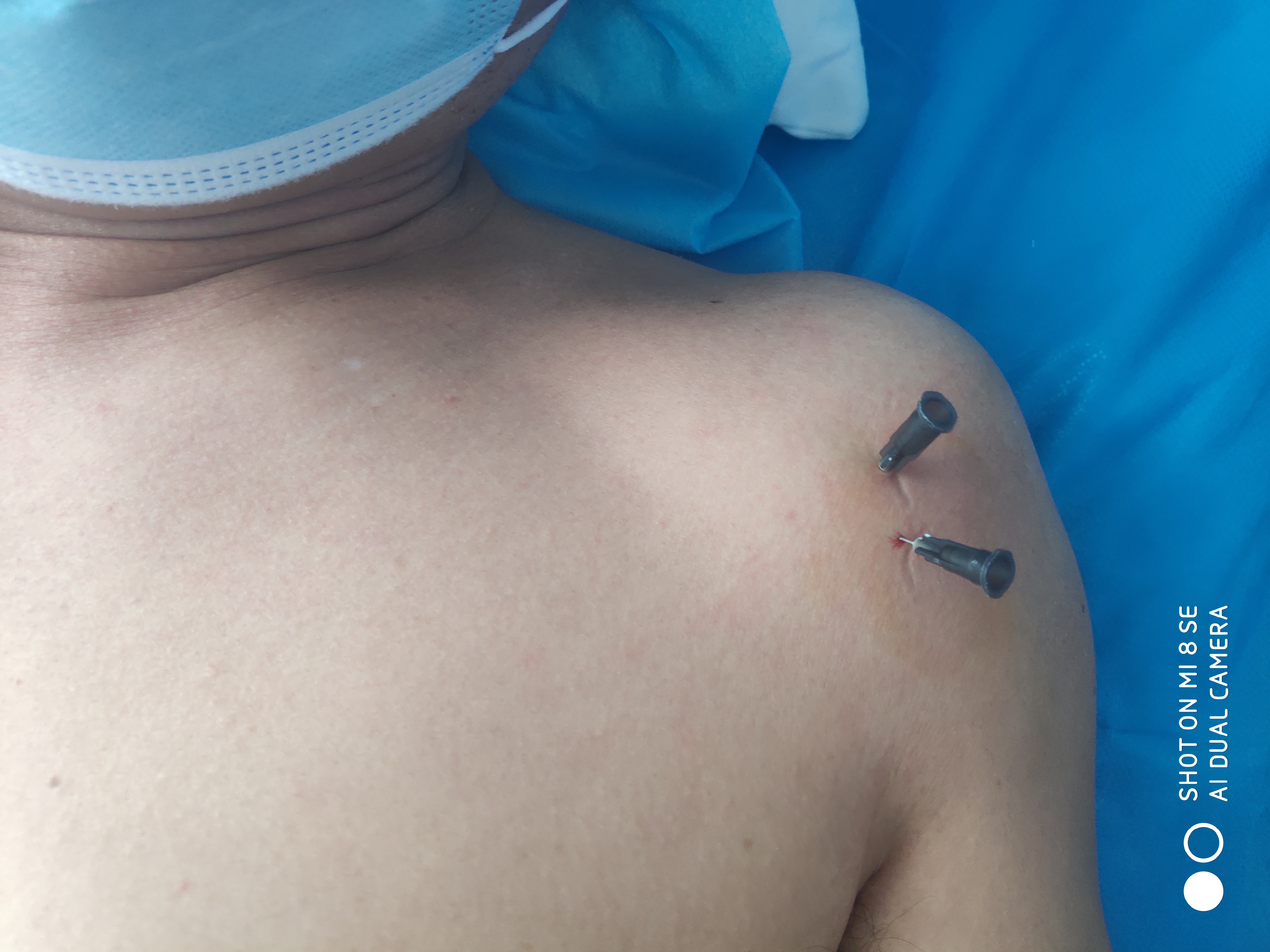 弧刃针怎么操作视频教程,弧刃针的危害