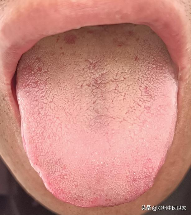 尿毒症治愈病例,中医治尿毒症医案