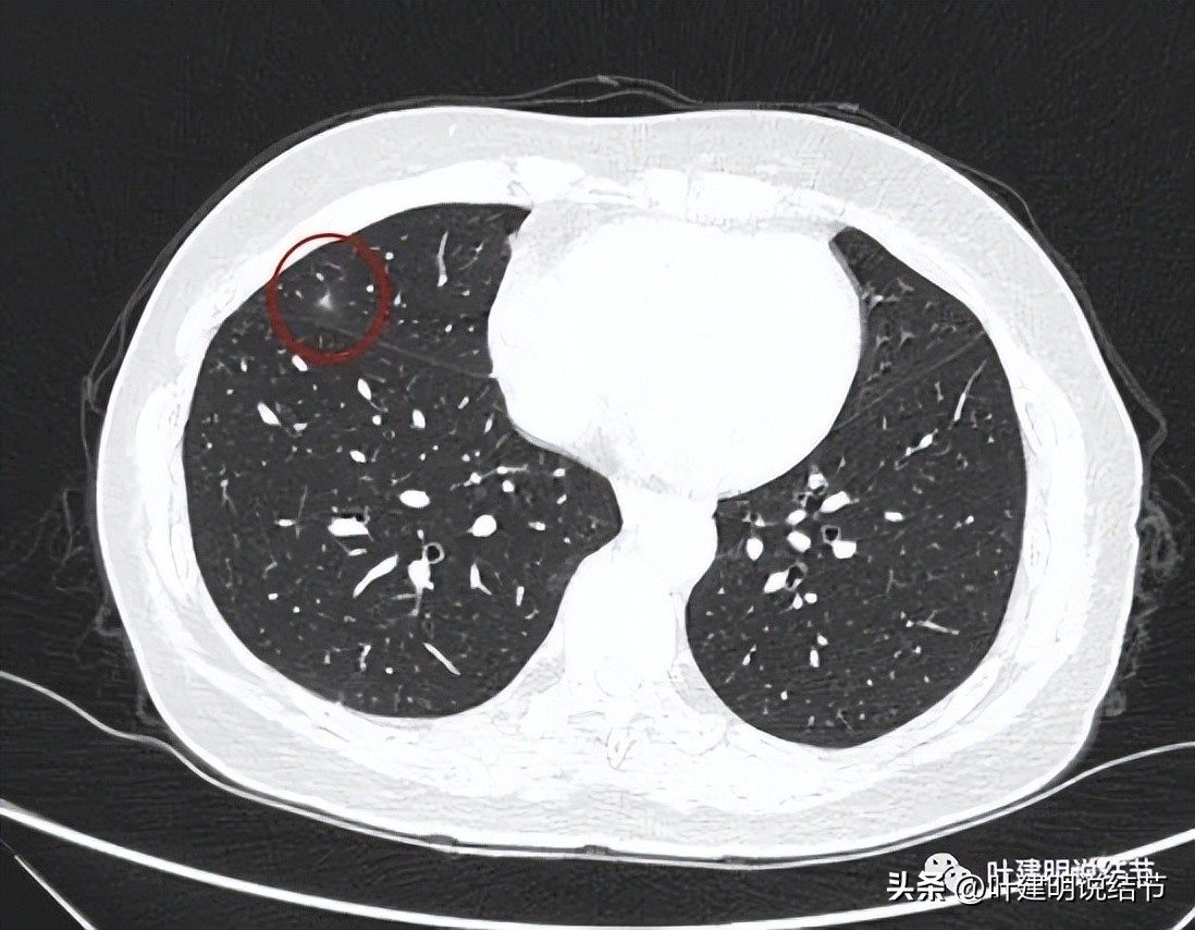 辽宁省肺结节手术哪家医院好,辽宁肺结节手术医院
