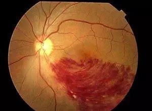 高度近视眼底黄斑病好治吗,高度近视检查眼底就行了吗