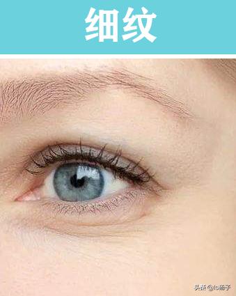 干纹细纹怎么去除最好,皱纹细纹和干纹的区别及解决方法