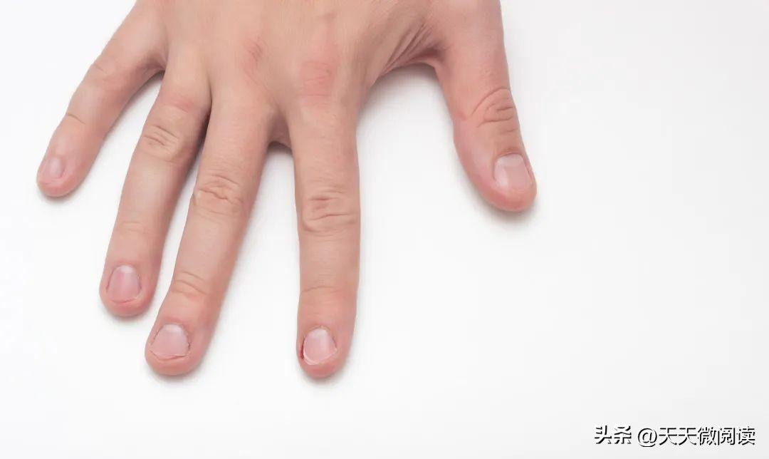 大拇指甲上有白色竖纹是怎么回事,左手大拇指指甲有黑竖纹怎么回事