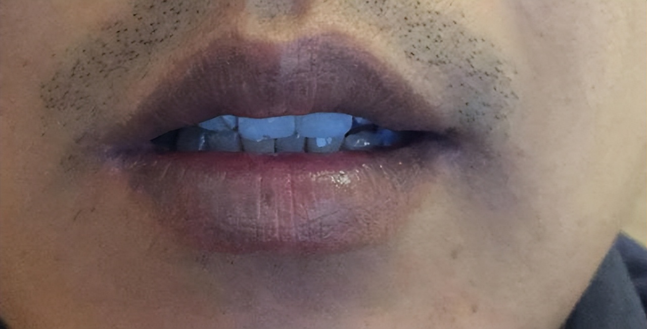 血液浓度高会引起哪些病,血液浓度高有什么好处