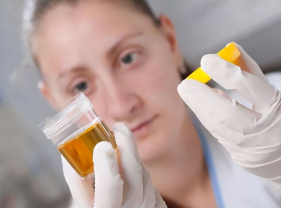 男人尿多警惕尿毒症,男人得了尿毒症会有什么表现