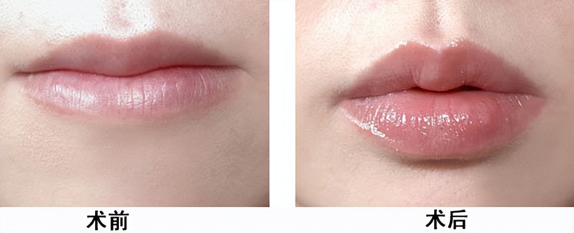 嘴唇很薄打玻尿酸丰唇效果,薄嘴唇玻尿酸丰唇