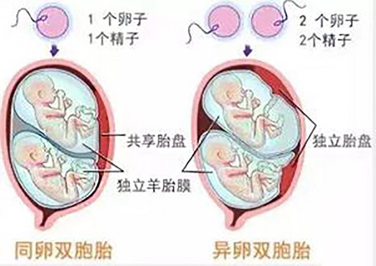 只有一个精子怎么会有双胞胎,只有一个精子正常能受孕吗