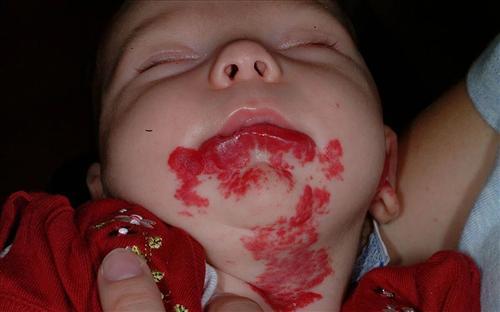 婴幼儿血管瘤会自行消退？小心长在这些部位的“瘤”，或危及生命