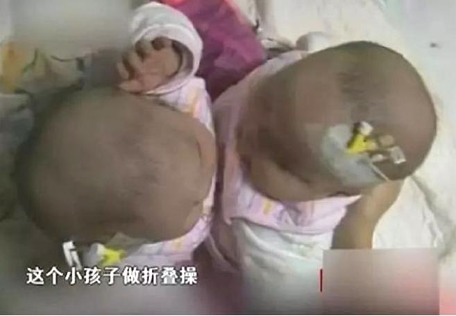 中国首例坐骨连体婴,坐骨连体姐妹分离成功了吗