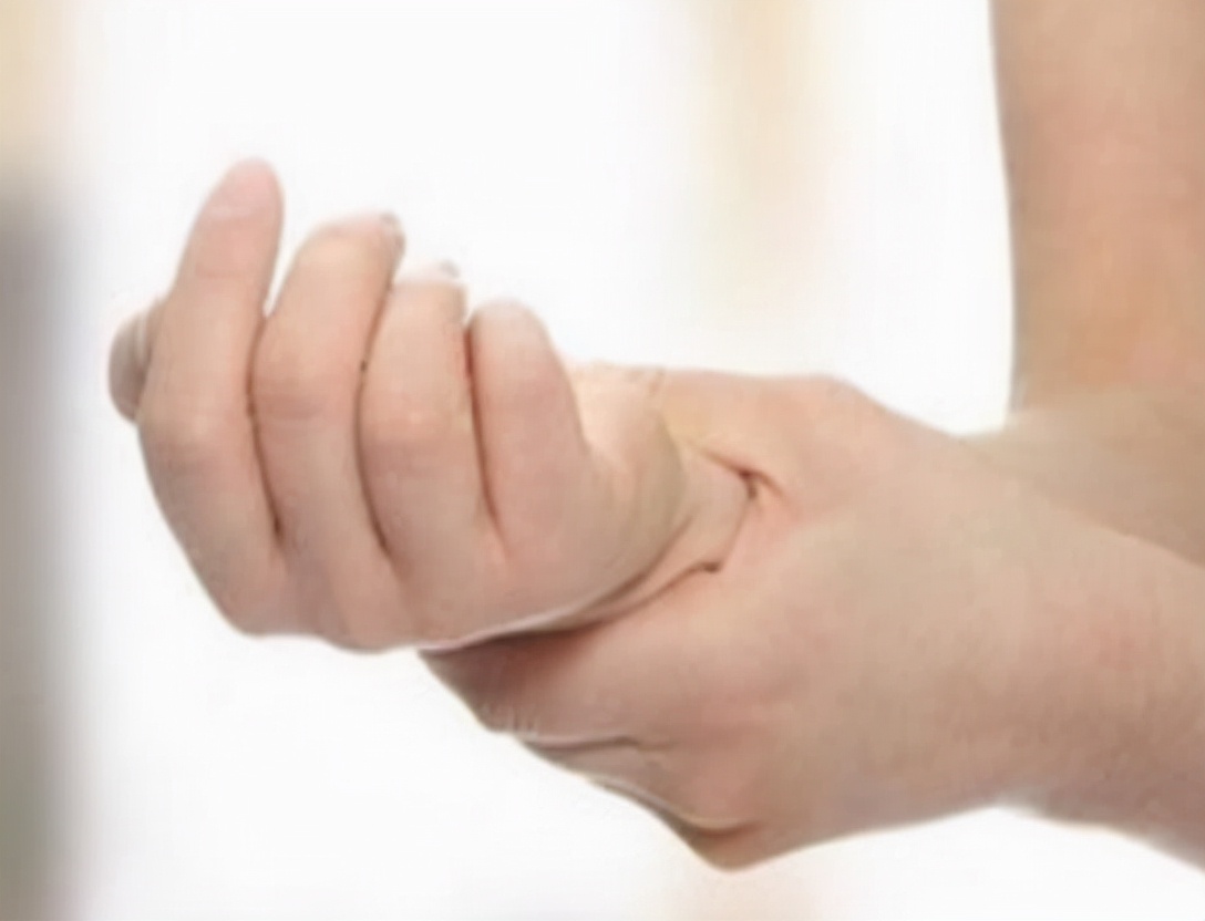 更年期女性手指腱鞘炎,女性绝经易患屈指腱鞘炎吗