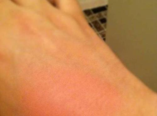 被开水烫伤怎么办最快最有效,不小心被开水烫了怎么快速处理