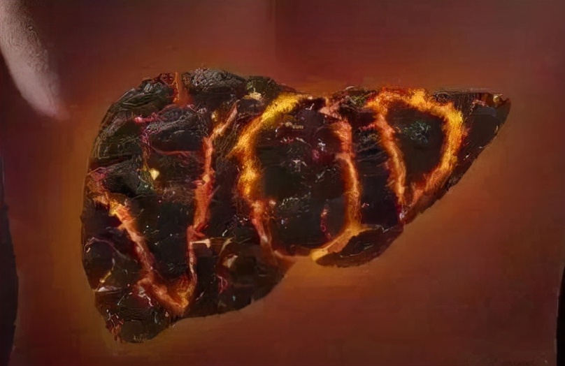 身上有蜘蛛痣都是肝硬化吗,出现蜘蛛痣是肝硬化引起的吗