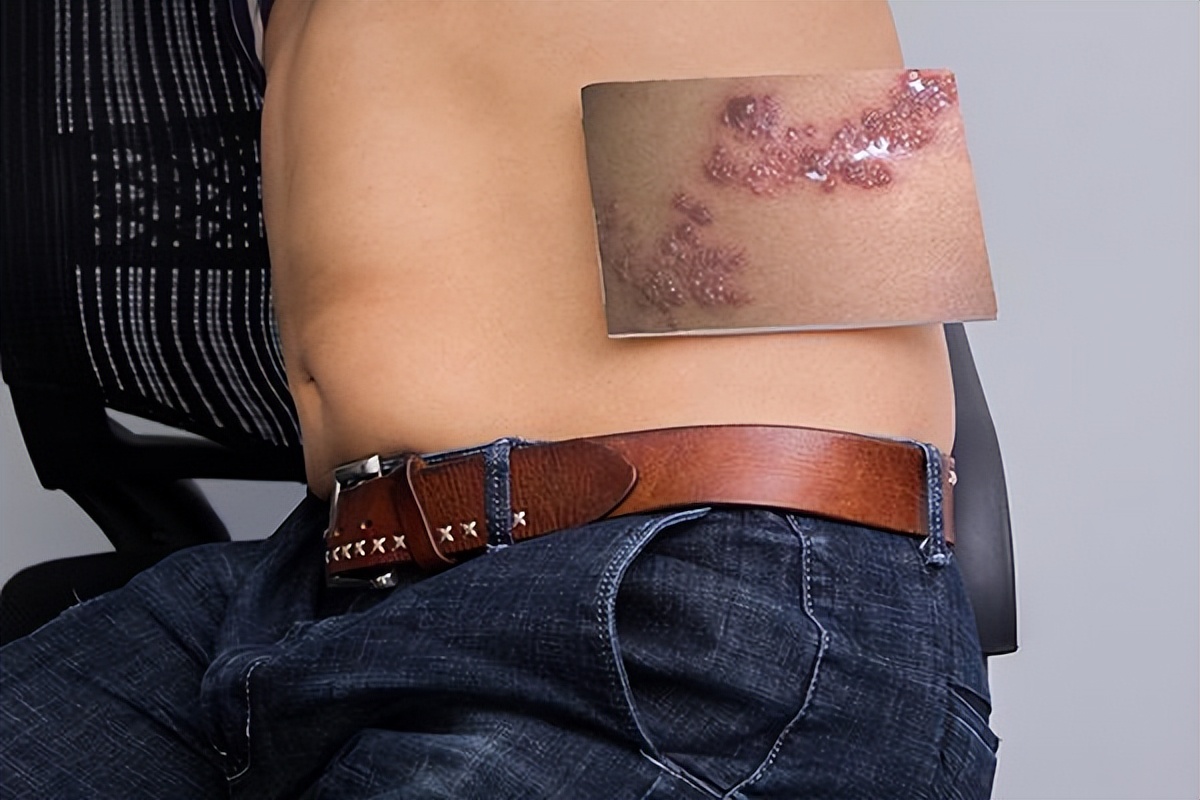 蛇盘疮越长越多怎么办,蛇盘疮腰缠一圈真的会要人命吗