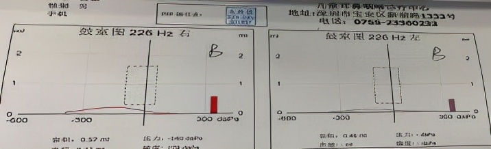 分泌性中耳炎引起的传导性耳聋,儿童急性分泌性中耳炎会致耳聋吗