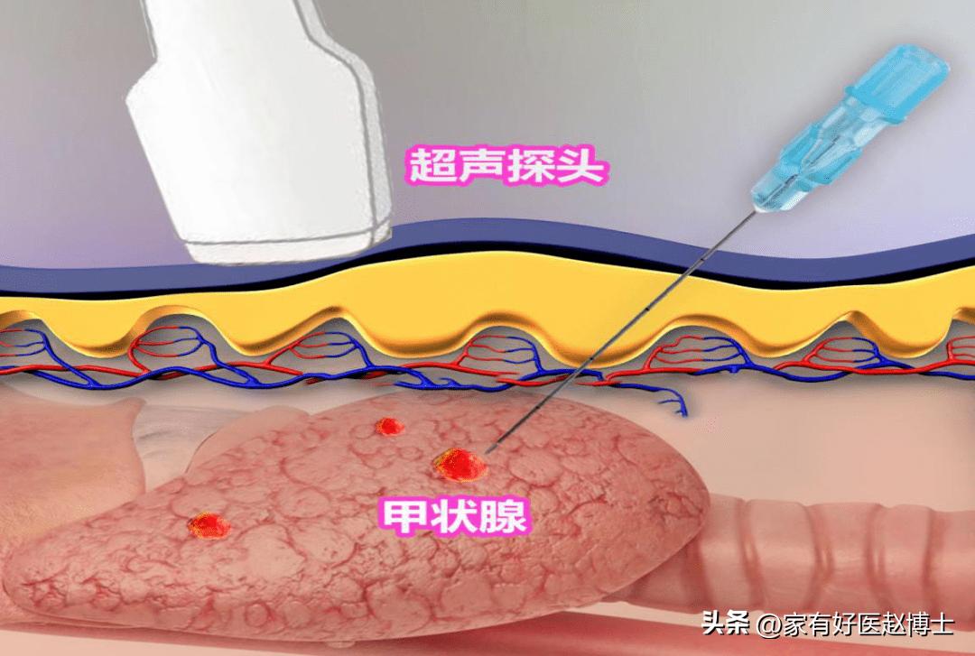 甲状腺结节诊治指南再更新,风险高低怎么看?哪些结节要穿刺?
