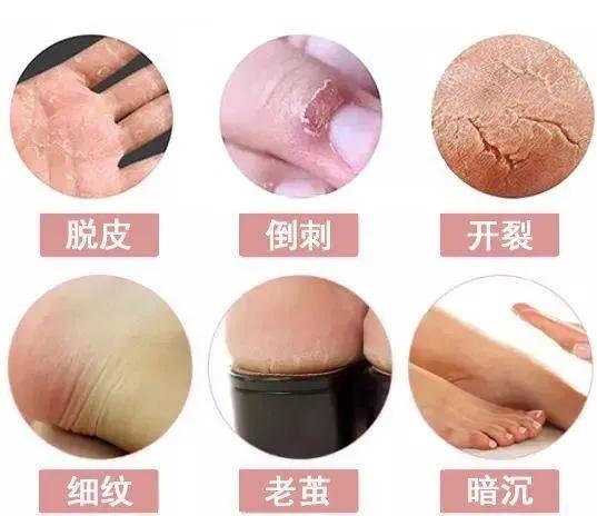 又痒又臭的脚气怎么处理,感觉要得脚气了怎么预防