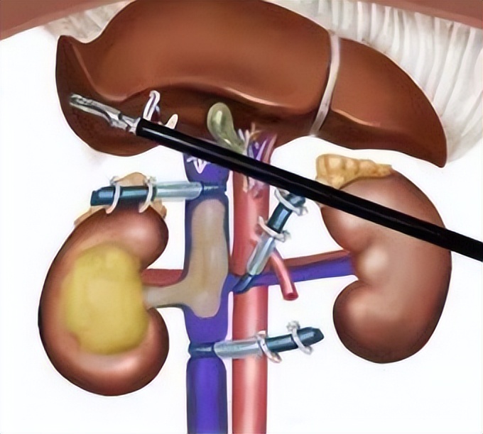山西白求恩医院泌尿外科开展医院首例机器人辅助腹腔镜下根治性肾切除联合下腔静脉瘤栓取出术