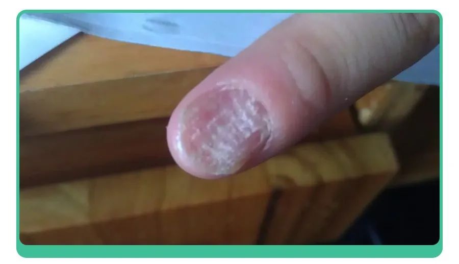 小孩指甲凹陷变黑有坑是什么原因,小孩指甲有白点和细纹是怎么回事