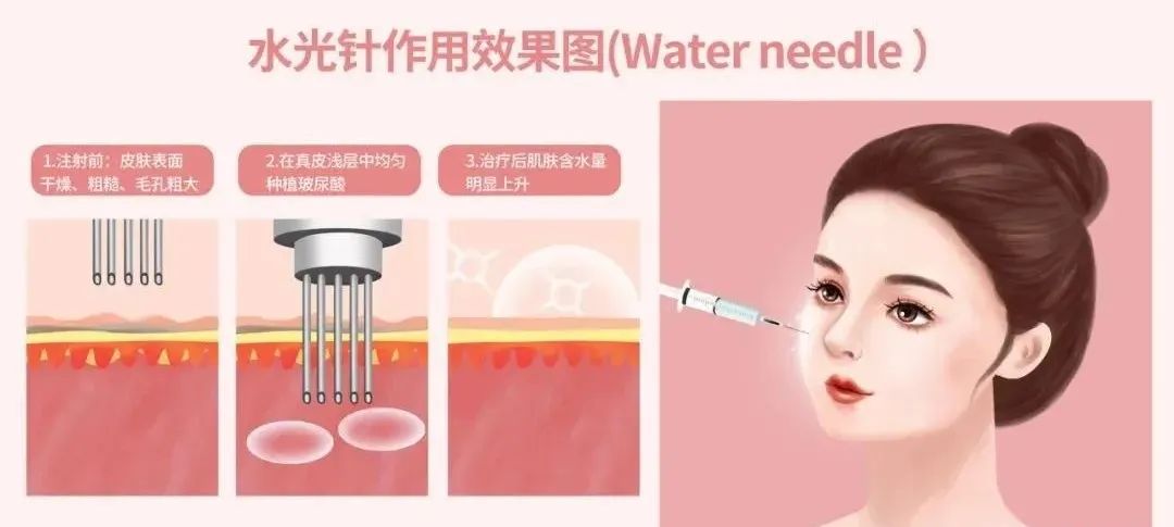 ——拿什么来拯救我的夏日底妆*水光针