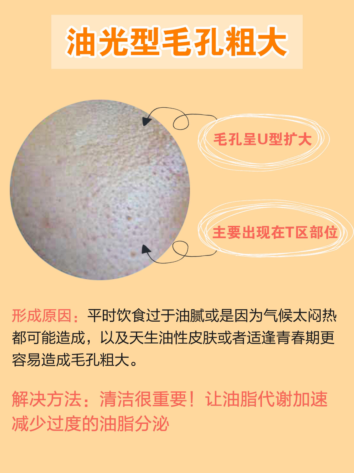 毛孔粗大也有办法改善皮肤科普,毛孔粗大最全攻略解决办法