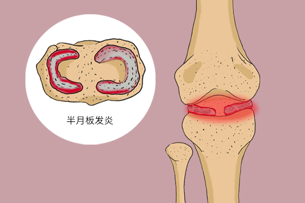 半月板磨损膝盖疼痛如何治疗,膝盖疼痛半月板磨损一招解决
