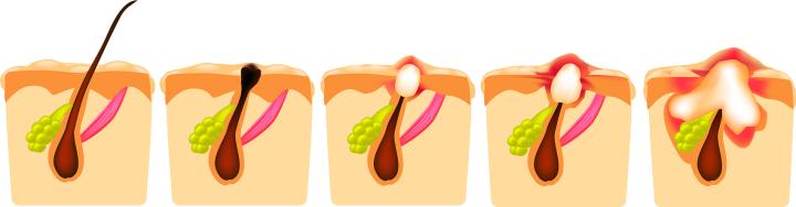 毛囊炎如何治疗？红蓝光高效治疗