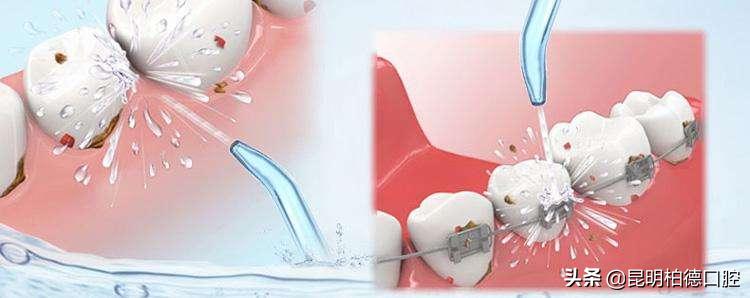 洗牙出血会被感染传染病吗,洗牙第二天牙龈出血有血块