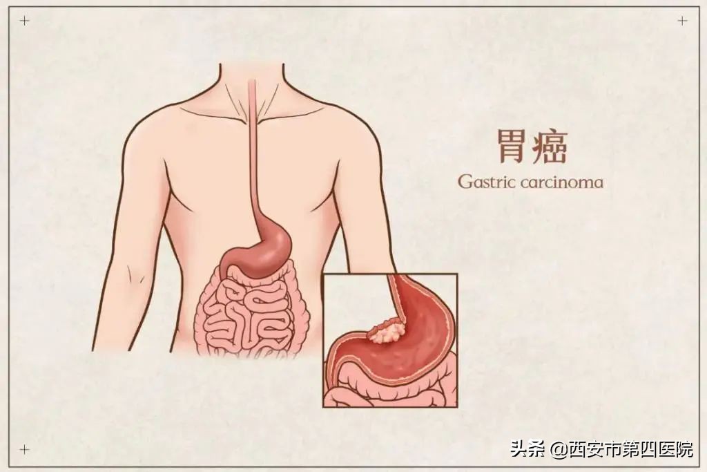 健康科普预防癌症,如何有效的预防癌症遗传