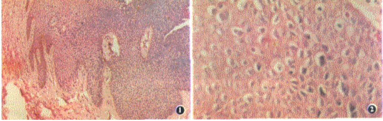 HPV感染可引发的另一种疾病——鲍温样丘疹病