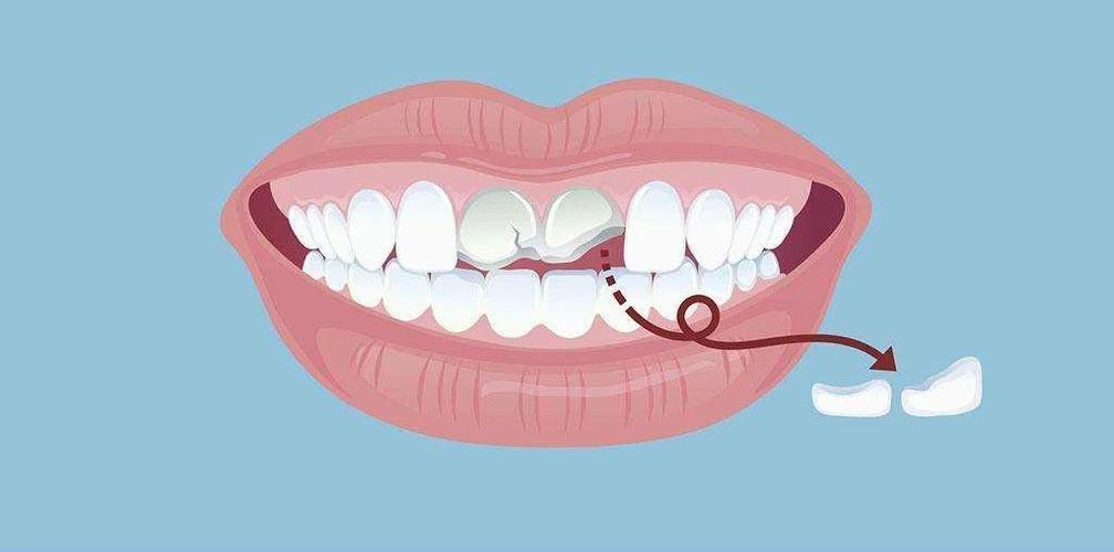 摔掉牙齿怎么补救,摔了一跤牙怎么快速牢固