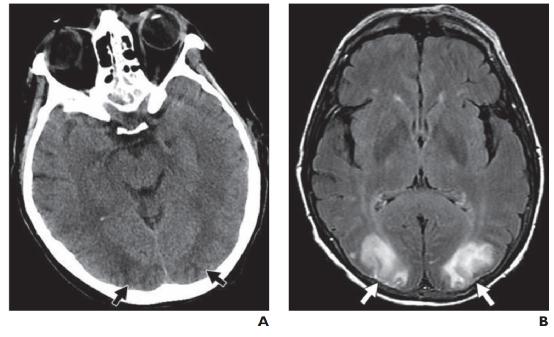 脑水肿的影像,脑水肿形成机制生理学