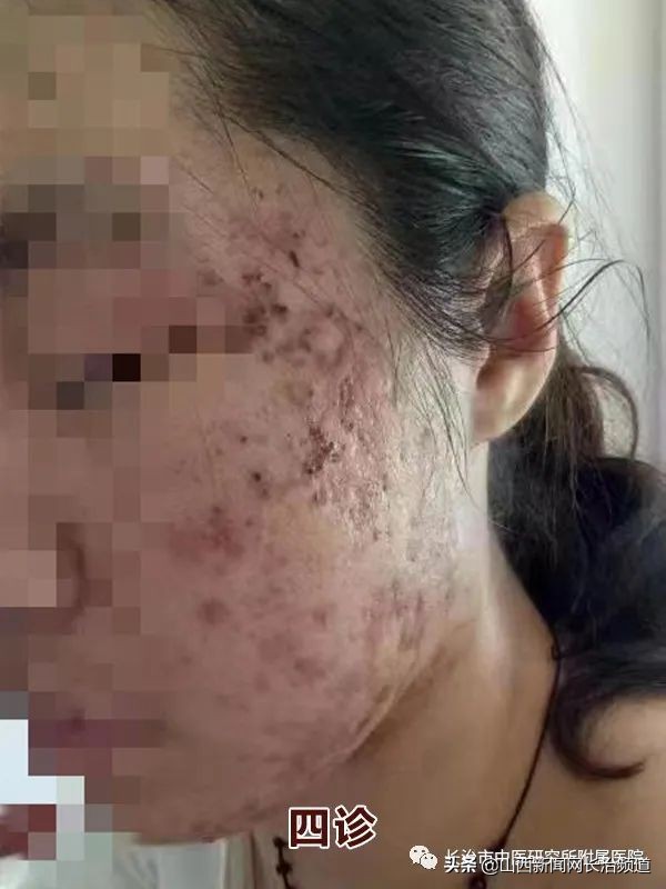 长治市中医研究所附属医院皮肤科用“火针+中药+倒模”疗法成功治疗一例中重度*疮痤**患者