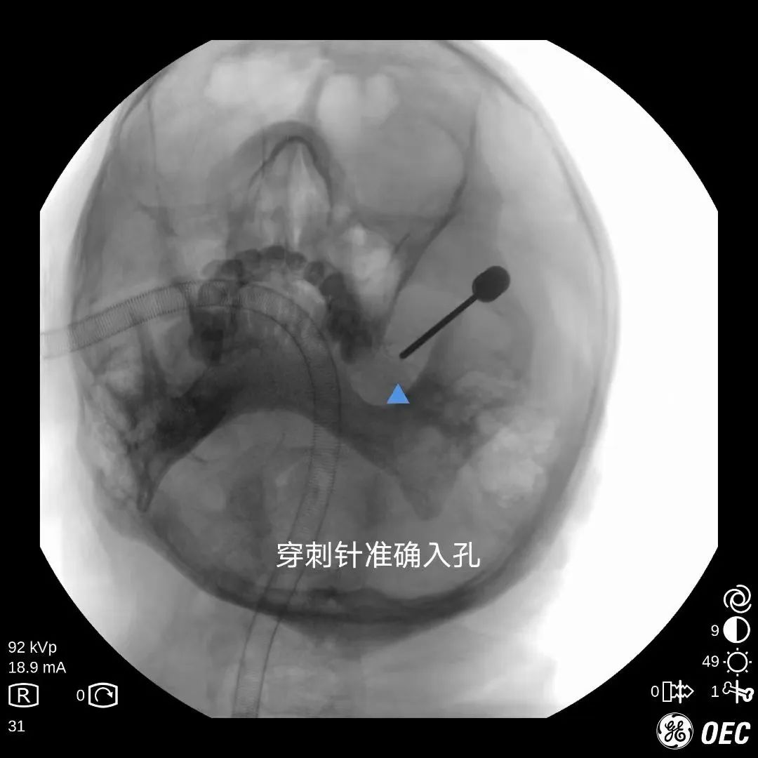 临汾治疗三叉神经痛多少钱,临汾市最好的三叉神经痛医院