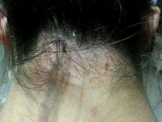 头皮老是长疙瘩和脓包是怎么了,头皮老是长疙瘩有脓包是什么原因